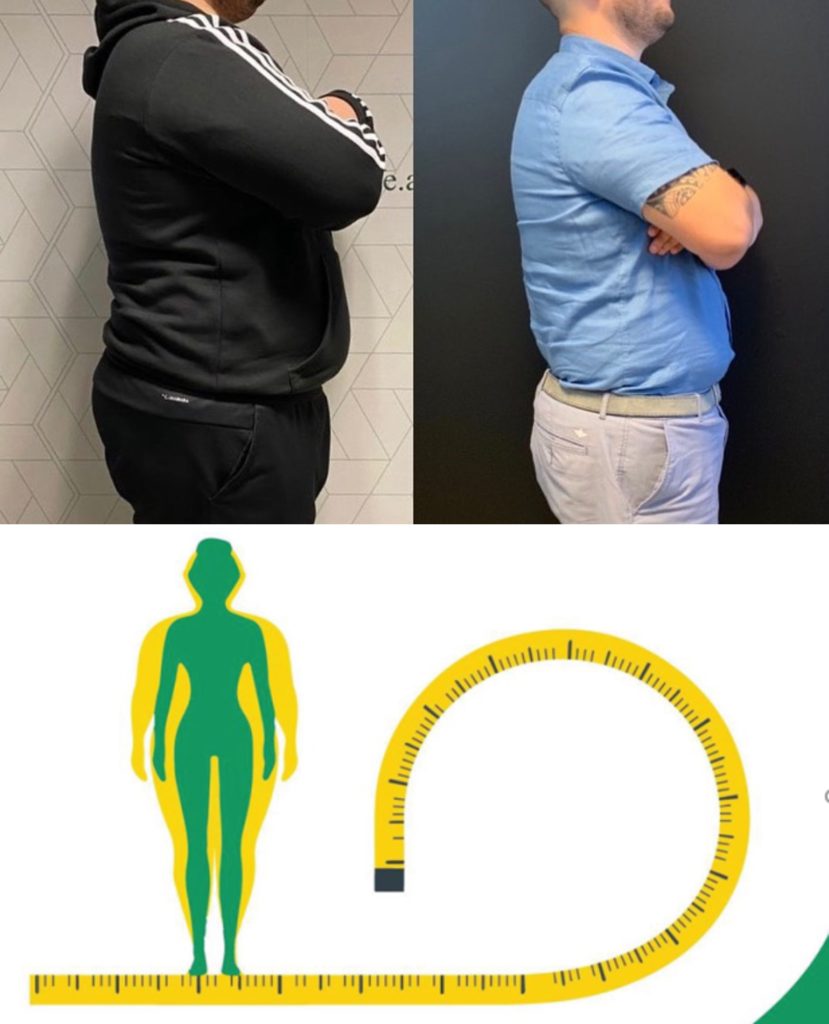 Përse çdo ditë e më shumë po përqafohet metoda e balonit gastrik?