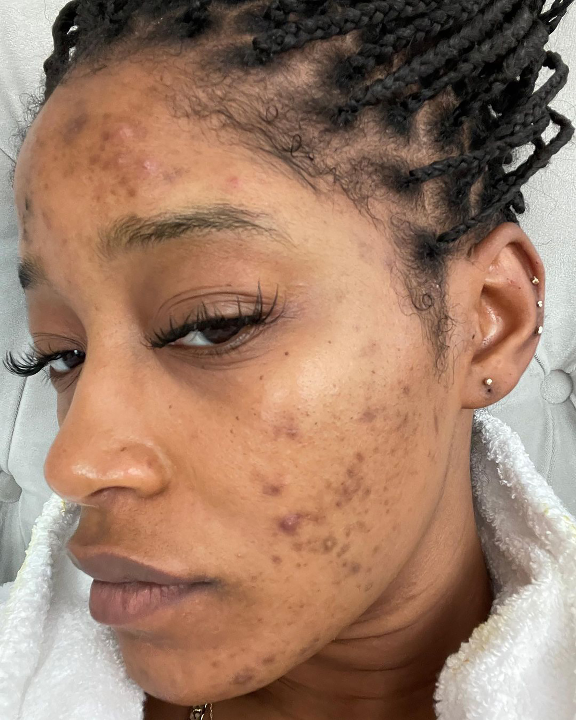 Problemet me aknet, aktorja e njohur revoltohet me mjekët: “Jam e lodhur”