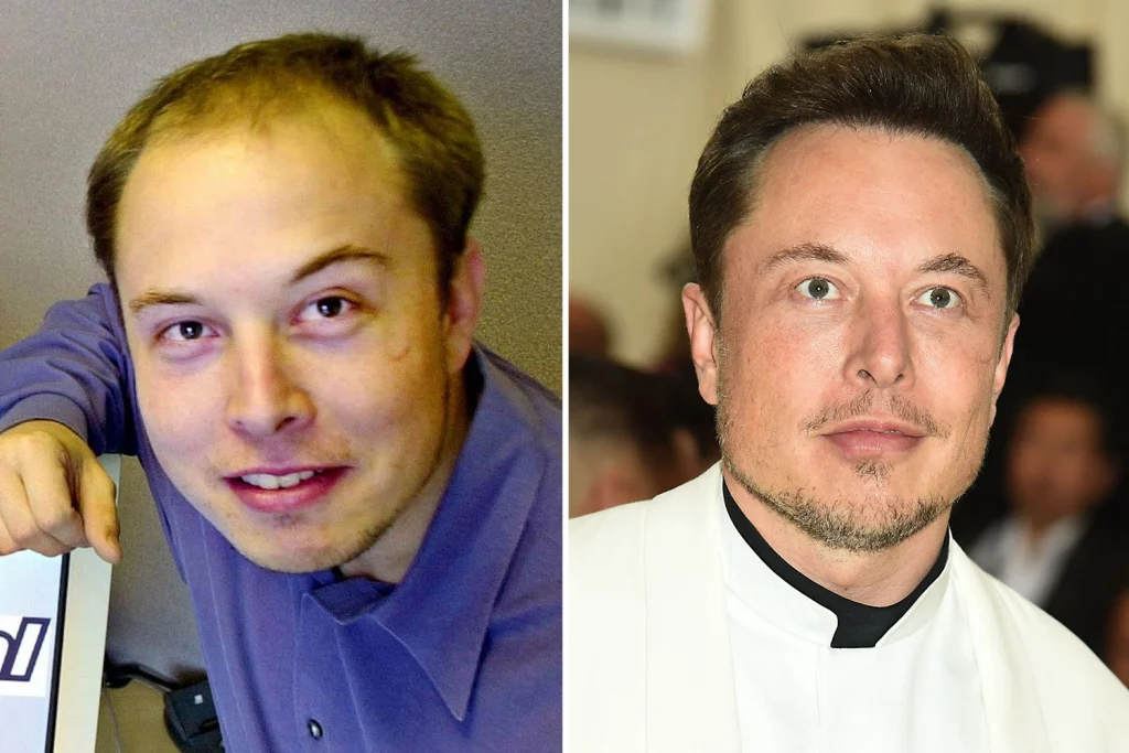 Mjeku e nxjerr zbuluar! Elon Musk ka shpenzuar shumën marramendëse për operacione plastike