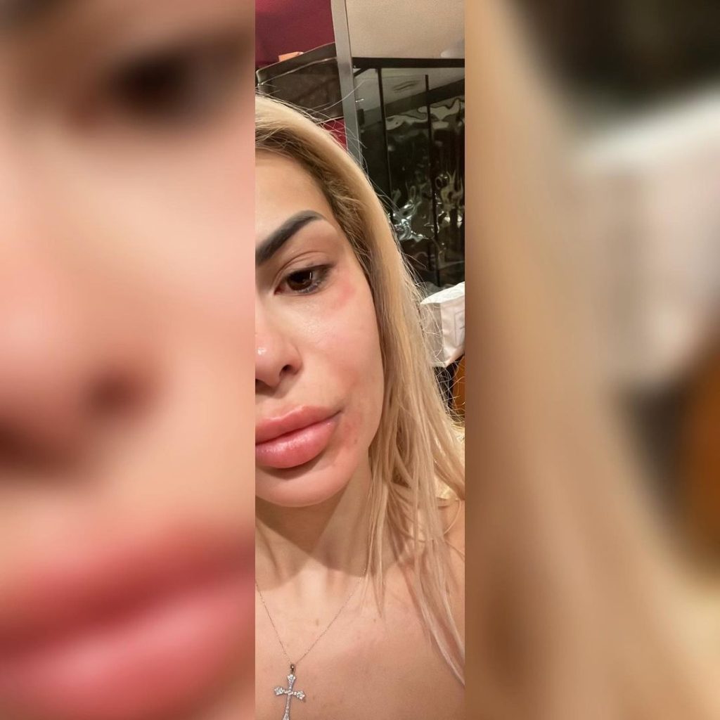 Pa make up dhe me këmbë të enjtura, Luana Vjollca tregon gjendjen e saj pas pune