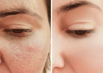 Disa metoda si t’i zvogëloni poret e zgjeruara në fytyrë