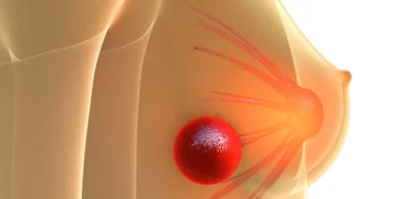 Gjëndra nuk është i vetmi tregues, shenjat e tjera të kancerit të gjirit!