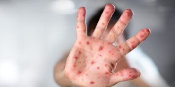 Rumania shpall epidemi të fruthit