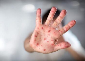 Konfirmohet në Shkodër rasti i parë me fruth, izolohet një i mitur