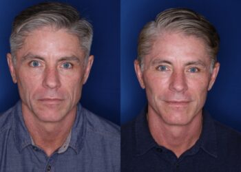 Më shumë se femrat, shuma që po paguajnë meshkujt për ngritje të fytyrës