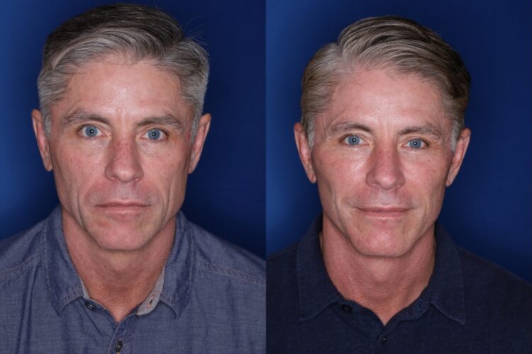 Më shumë se femrat, shuma që po paguajnë meshkujt për ngritje të fytyrës