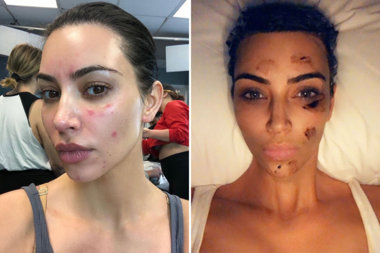 I dinit?! Këto janë 5 shkaqet e shpërthimit të akneve