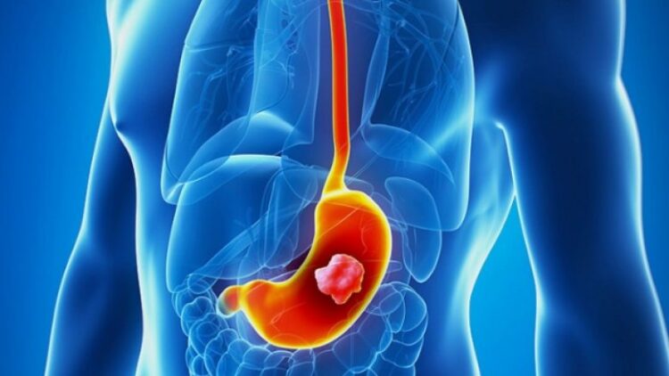 Çfarë ushqimesh duhet të hani nëse keni ulçerë në stomak?