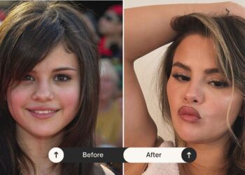 Si ishte si është! Selena Gomez pranon për herë të parë ndërhyrjet estetike