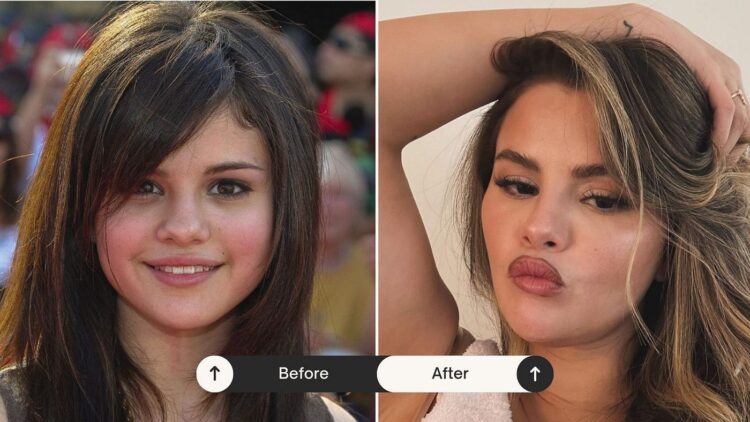 Si ishte si është! Selena Gomez pranon për herë të parë ndërhyrjet estetike