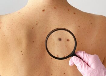 Një njollë e çuditshme nuk është e vetmja treguese e kancerit të lëkurës