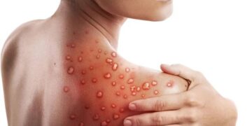 ALARM! Shënohet rasti i parë me linë e majmunëve