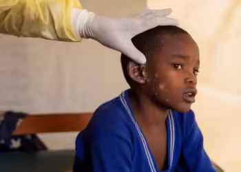 Ethet deri në dhimbje koke: Njihni simptomat e mpox, çfarë të bëni nëse infektoheni