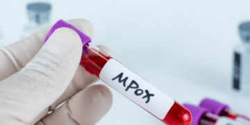 Lija e majmunit/Shkencëtarët ngrenë alarmin: Virusi po ndryshon më shpejt seç pritej