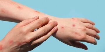 Konfirmohet rasti i parë me linë e majmunëve në Kosovë