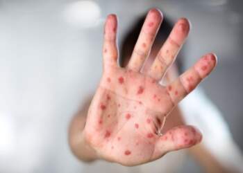 Rritja e rasteve me fruth: Ekspertja apelon për vaksinimin e fëmijëve