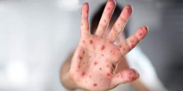 Rritja e rasteve me fruth: Ekspertja apelon për vaksinimin e fëmijëve