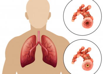 Rriten rastet me sëmundje pulmonare, mbi 70% në stade të avancuara