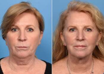 Transformimi i befasishem i një gruaje 60-vjeçare para dasmës së vajzës