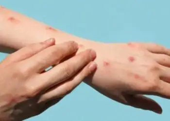 Lija e majmunit ‘prek’ dhe Maqedoninë e Veriut, konfirmohen dy raste