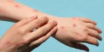 Lija e majmunit ‘prek’ dhe Maqedoninë e Veriut, konfirmohen dy raste