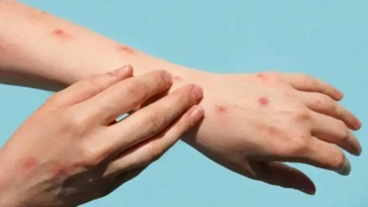 Lija e majmunit ‘prek’ dhe Maqedoninë e Veriut, konfirmohen dy raste