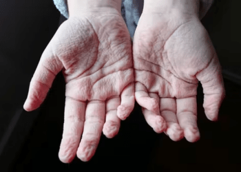 Ja arsyeja e vërtetë pse gishtat rrudhen në ujë