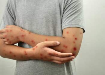 Rasti i parë me linë e majmunit në Shqipëri, çfarë dihet deri tani