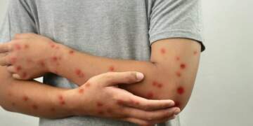 Rasti i parë me linë e majmunit në Shqipëri, çfarë dihet deri tani