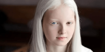 Një bukuri që sfidon paragjykimet! 13 Qershori, Dita Ndërkombëtare e Ndërgjegjësimit për Albinizmin