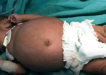 Foshnja që mbante binjakun e saj në bark, historia që tronditi mjekët!