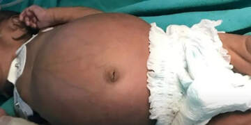 Foshnja që mbante binjakun e saj në bark, historia që tronditi mjekët!