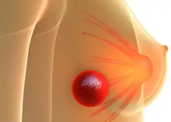 Përparim i madh në kancerin e gjirit, shkencëtarët zbulojnë një mënyrë për të parandaluar sëmundjen