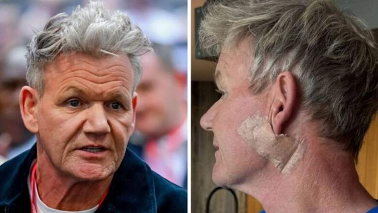 Gordon Ramsay kalon nëpër një operacion për kancerin e lëkurës: Mesazhi i tij për fansat