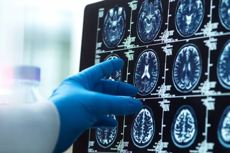 Çfarë është sëmundja e Huntingtonit që për herë të parë u trajtua me sukses