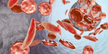 Alarm për shëndetin e grave në Shqipëri! 25% të prekura nga anemia