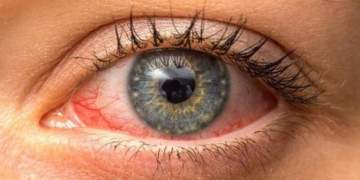 Pse thahen sytë dhe si mund t’i përshtatni kurat natyrale