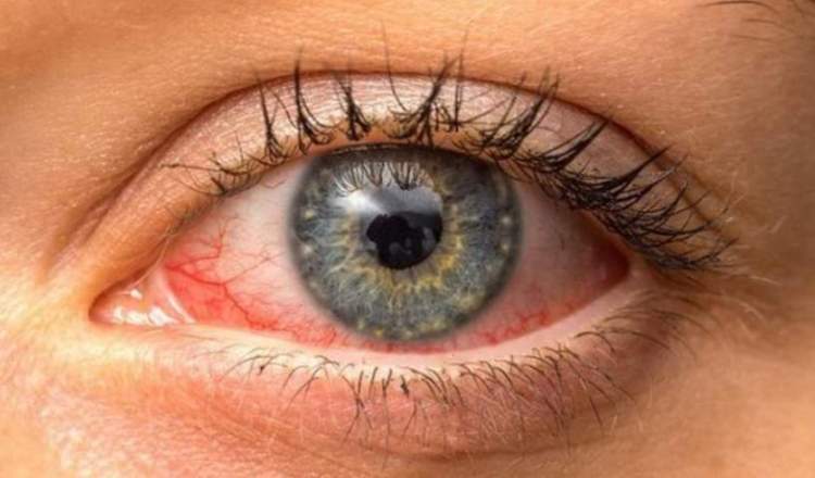 Pse thahen sytë dhe si mund t’i përshtatni kurat natyrale