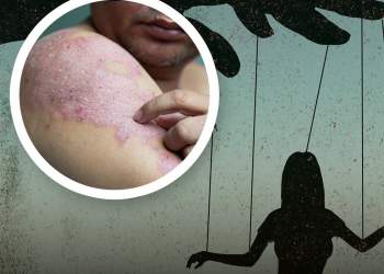 Studimet tregojnë: Të thuash ‘Po’ shumë shpesh mund të çojë në sëmundje autoimune