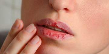 Pse buzët tuaja janë gjithmonë të thata dhe të plasaritura?