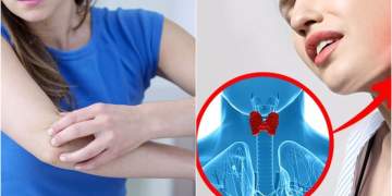 Çfarë tregojnë duart për shëndetin e tiroides? Shenjat paralajmëruese