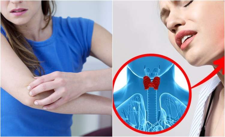 Çfarë tregojnë duart për shëndetin e tiroides? Shenjat paralajmëruese