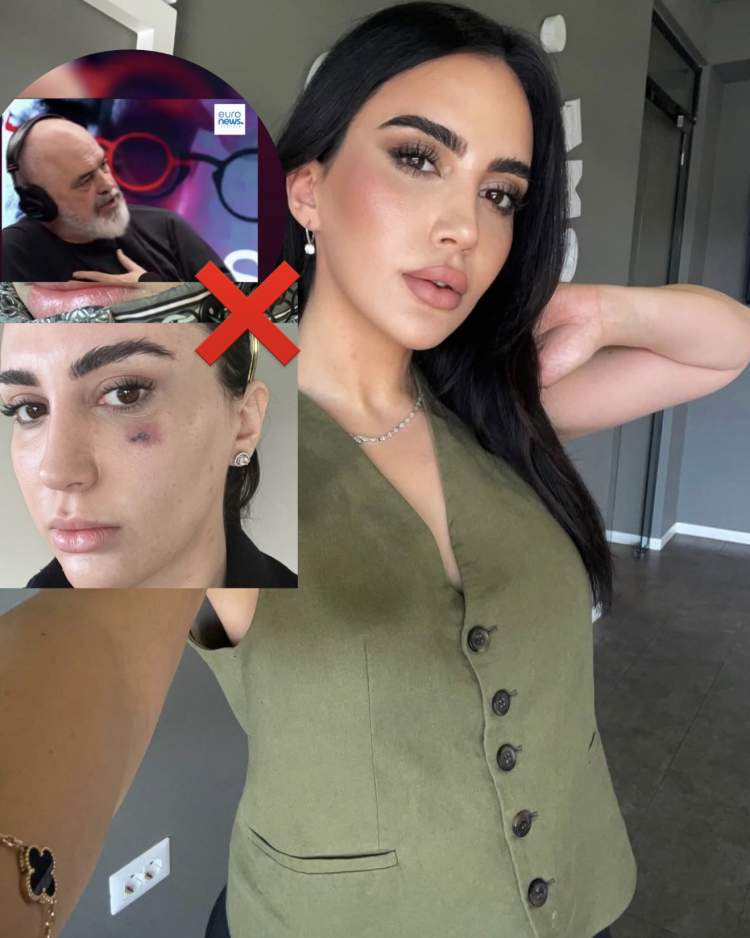 “Më përdorën si kavie”/ Gazetarja me akuza të forta për neglizhencë mjekësore ndaj klinikës së shfaqur në podcastin e Ramës