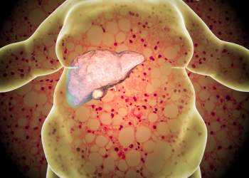 Njihuni me MASLD: sëmundja që sulmon mëlçinë në heshtje dhe rrit rrezikun për diabet dhe zemër