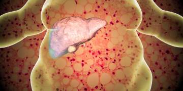 Njihuni me MASLD: sëmundja që sulmon mëlçinë në heshtje dhe rrit rrezikun për diabet dhe zemër