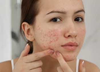 Shenjat në fytyrë që mund të paralajmërojnë për probleme me mëlçinë