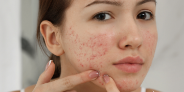 Shenjat në fytyrë që mund të paralajmërojnë për probleme me mëlçinë